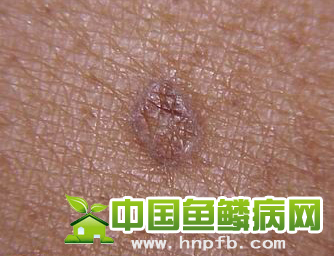 毛囊角化症图片 毛囊角化治疗