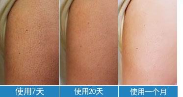 毛周角化