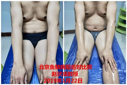 开封鱼鳞病的主要特征