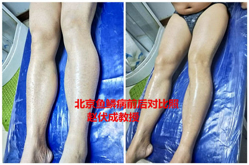 鱼鳞皮肤蛇皮癣是什么造成的呢