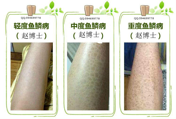 鱼鳞病患者要想避免把病情遗传给下一代
