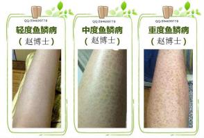 人类皮肤鱼鳞病健康的第二大“癌症”