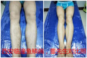 陕西西安市临潼区典型鱼鳞病治疗病例