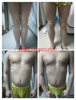 临床各种鱼鳞病偏方在这里看看