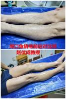 河南周口太康县鱼鳞病患者康复出院前后对比照图片