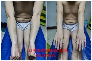 运城市治疗鱼鳞病医院哪家比较好