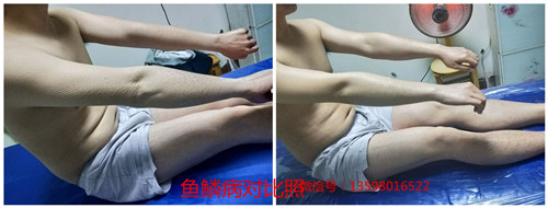 雅安市 真的可以治愈鱼鳞病吗
