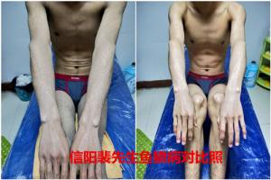 广元市治疗鱼鳞病哪家好比较好