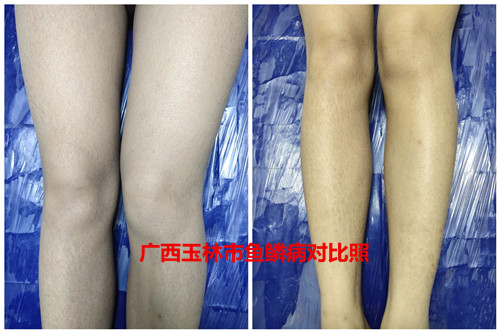 广西玉林市博白县XX村鱼鳞病患者康复出院图片对比照