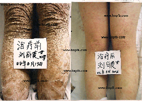 皮肤病鱼鳞病患者会患上抑郁症或者焦虑症吗
