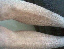 预防鱼鳞病感染需要怎么做