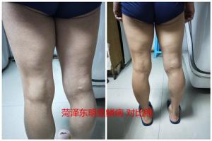 人身上长的鱼鳞状物是什么