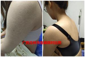 四肢的皮肤粗糙会是鱼鳞病症状吗