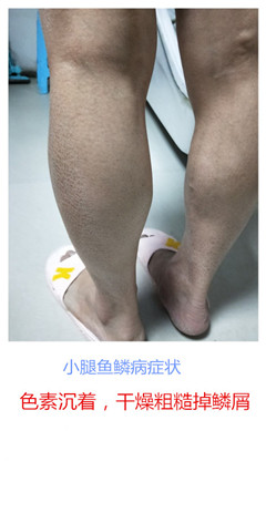 治疗鱼鳞病有什么偏方疗法吗